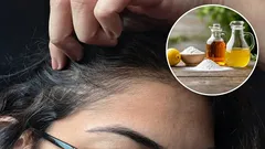 Aké sú výhody použitia octu a jedlej sódy na odstránenie šedín a ako to správne urobiť?